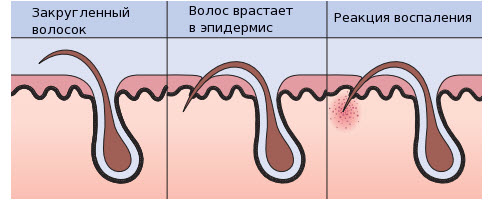 процесс врастания волос