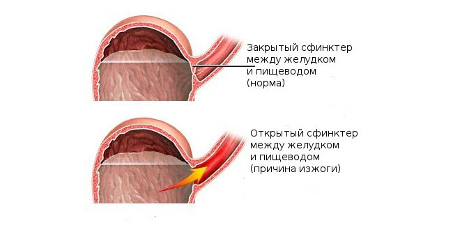 сфинктер при изжоге