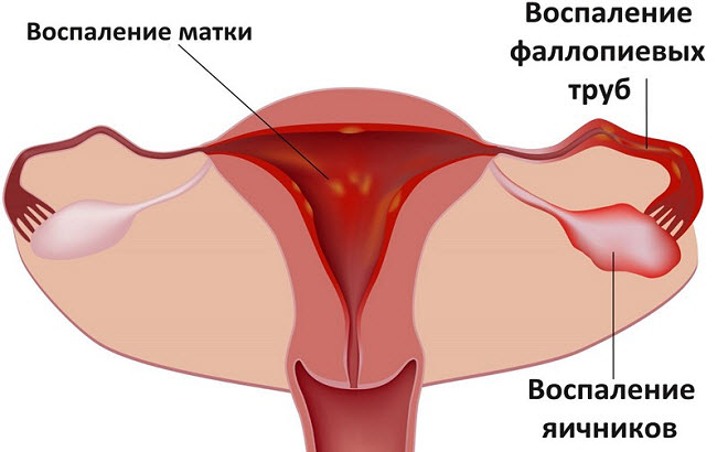 аднексит это
